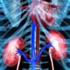 Combo Treatment Doubles Survival for Patients With Advanced Kidney Cancer